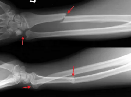 Fractures & Dislocations
